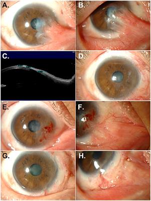 Superior outcome of labial mucosal autograft over limbal allograft in the management of recurrent pterygium with symblepharon: a case report